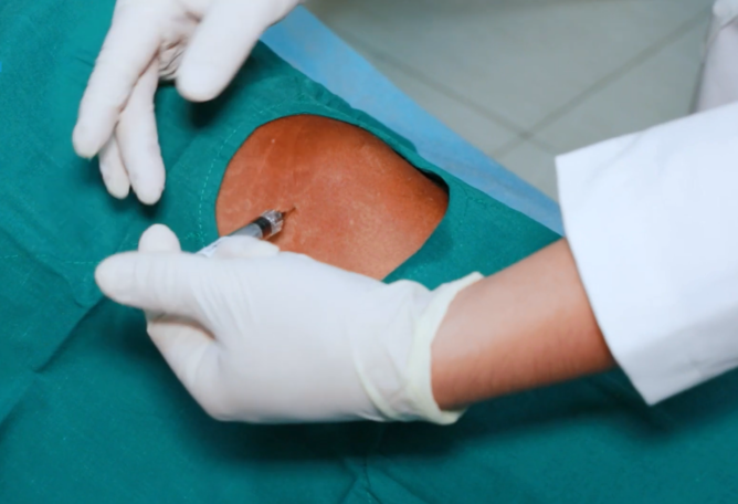 Lúc Nào Nên Tiêm Chất Nhờn vào Khớp Gối?