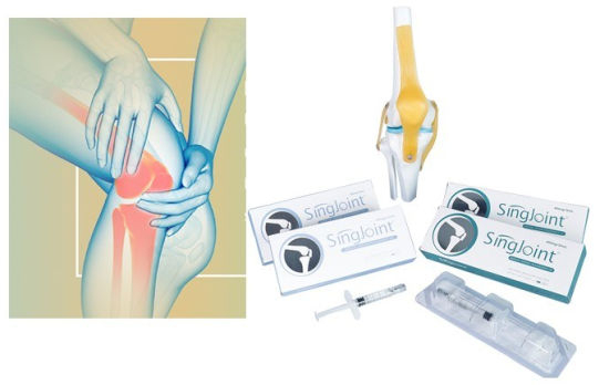 Singjoint - Giải Pháp Tiên Tiến Trong Điều Trị Thoái Hóa Khớp Gối