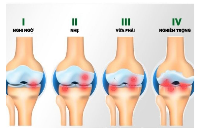 Các Giai Đoạn của Bệnh Thoái Hóa Khớp Gối