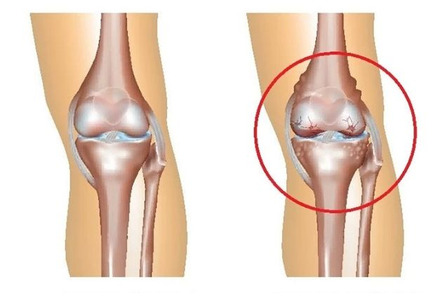 thoai hoa khop goi dan den ton thuong sun